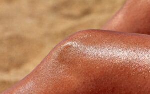 Güneş Yanıklarına Ne İyi Gelir