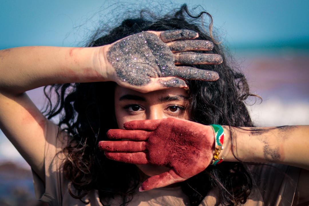 Vitiligoya ne iyi gelir ile ilgili görsel